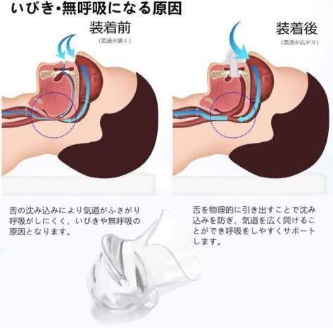 いびき防止グッズ ランキング 舌用マウスピース いびき対策 睡眠時の騒音 口呼吸_画像2