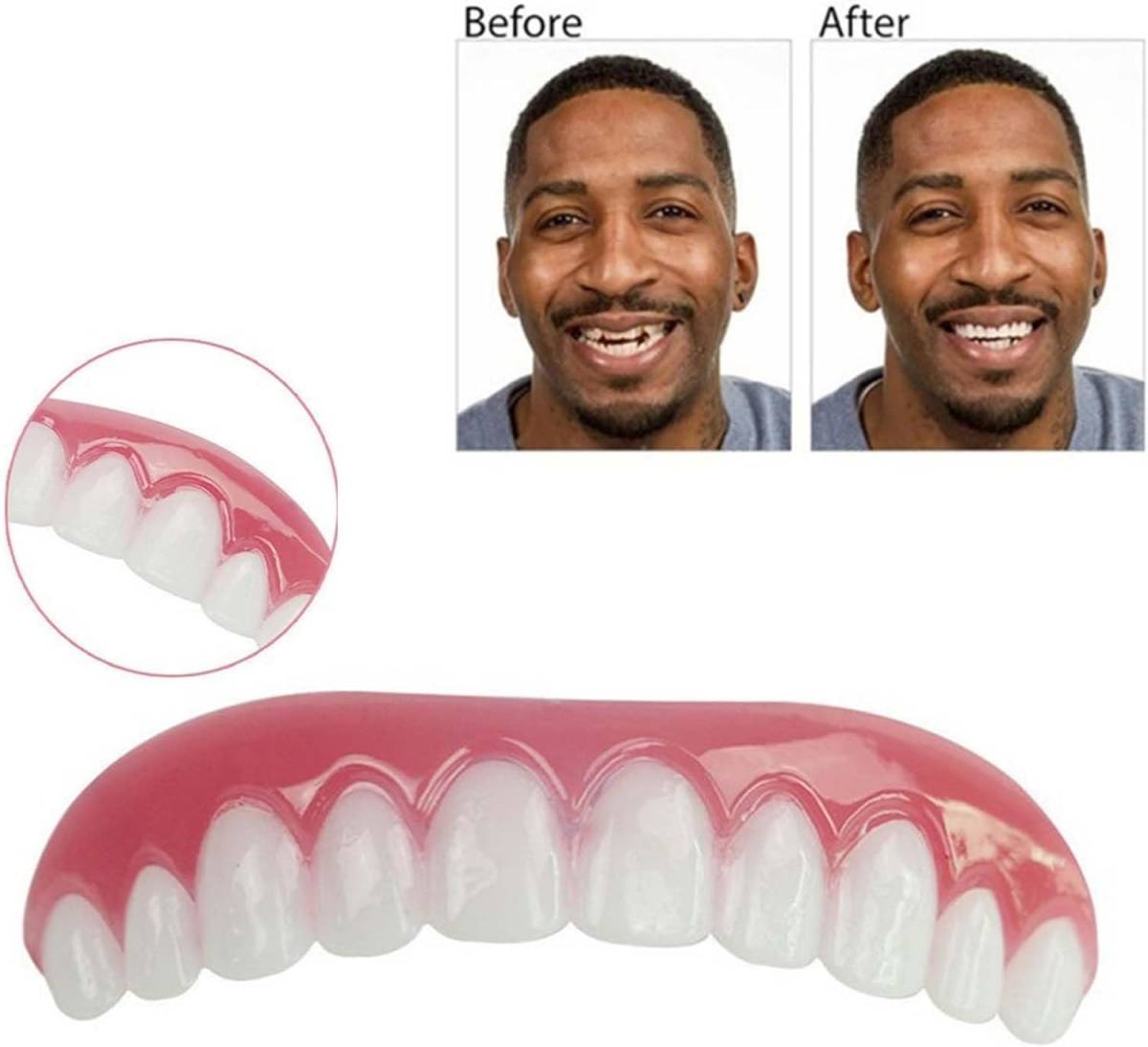 男性と女性の入れ歯、不完全な歯を覆い、自信のほほえみを修復する（2本）_画像4