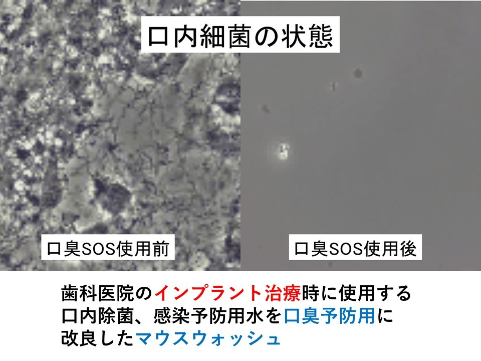 1 口臭SOS 口臭を消す 口臭ケア 口内ケア 口臭の原因 口臭チェッカー 口臭対策 口臭予防 マウスウオッシュ 口臭 口臭サプリの画像5