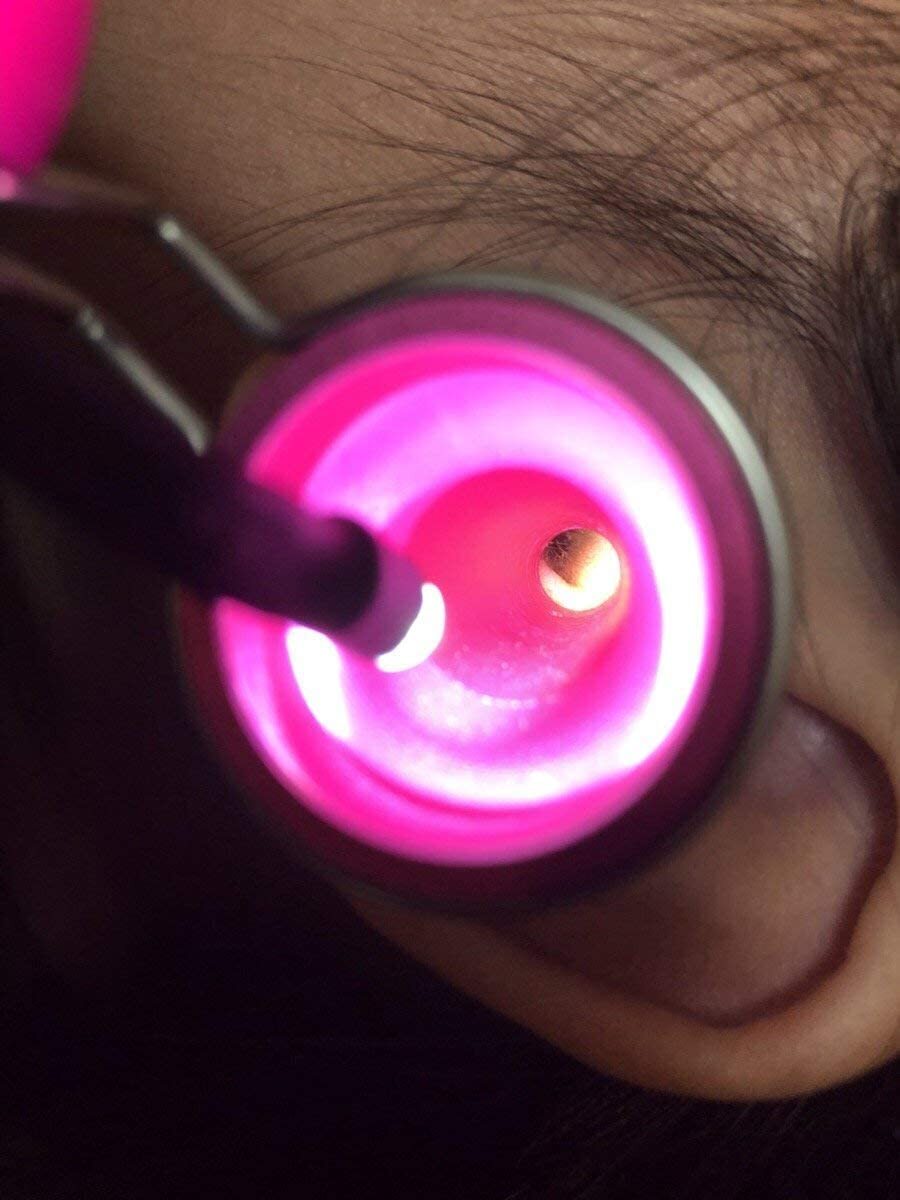 耳穴掃除セット 耳鏡 LEDライト付き 先端細ピンセット付き 2点セット / 医療用ライト 耳掃除器具 子供・大人兼用 (ピンク)_画像3