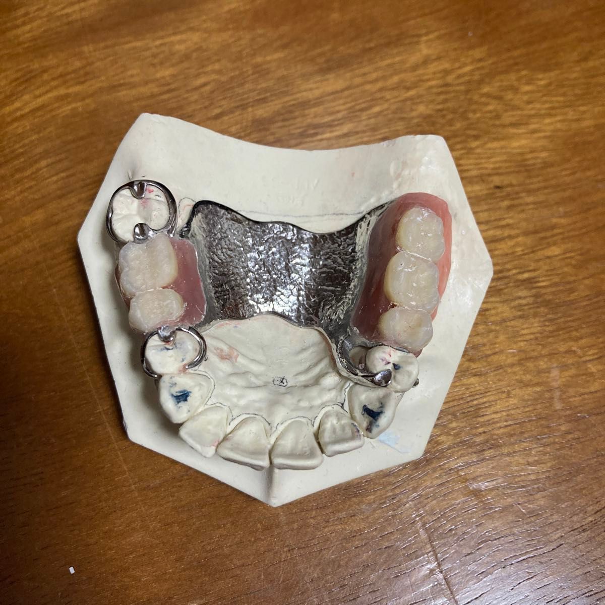 歯科　部分床義歯　サンプル