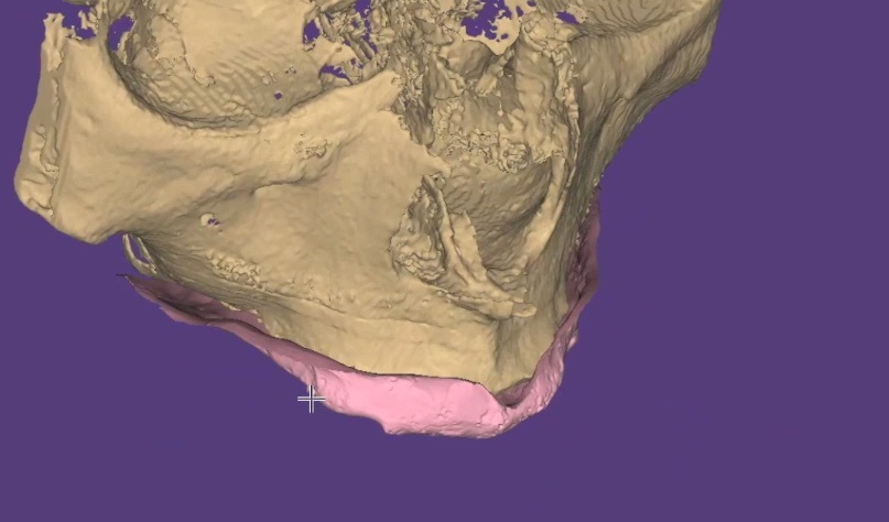 歯科 歯科技工 ダイコムデータから骨や歯のデータを抜き出す手順動画 mp4 CBCT の画像10