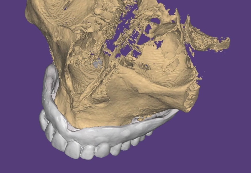 歯科 歯科技工 ダイコムデータから骨や歯のデータを抜き出す手順動画 mp4 CBCT の画像1
