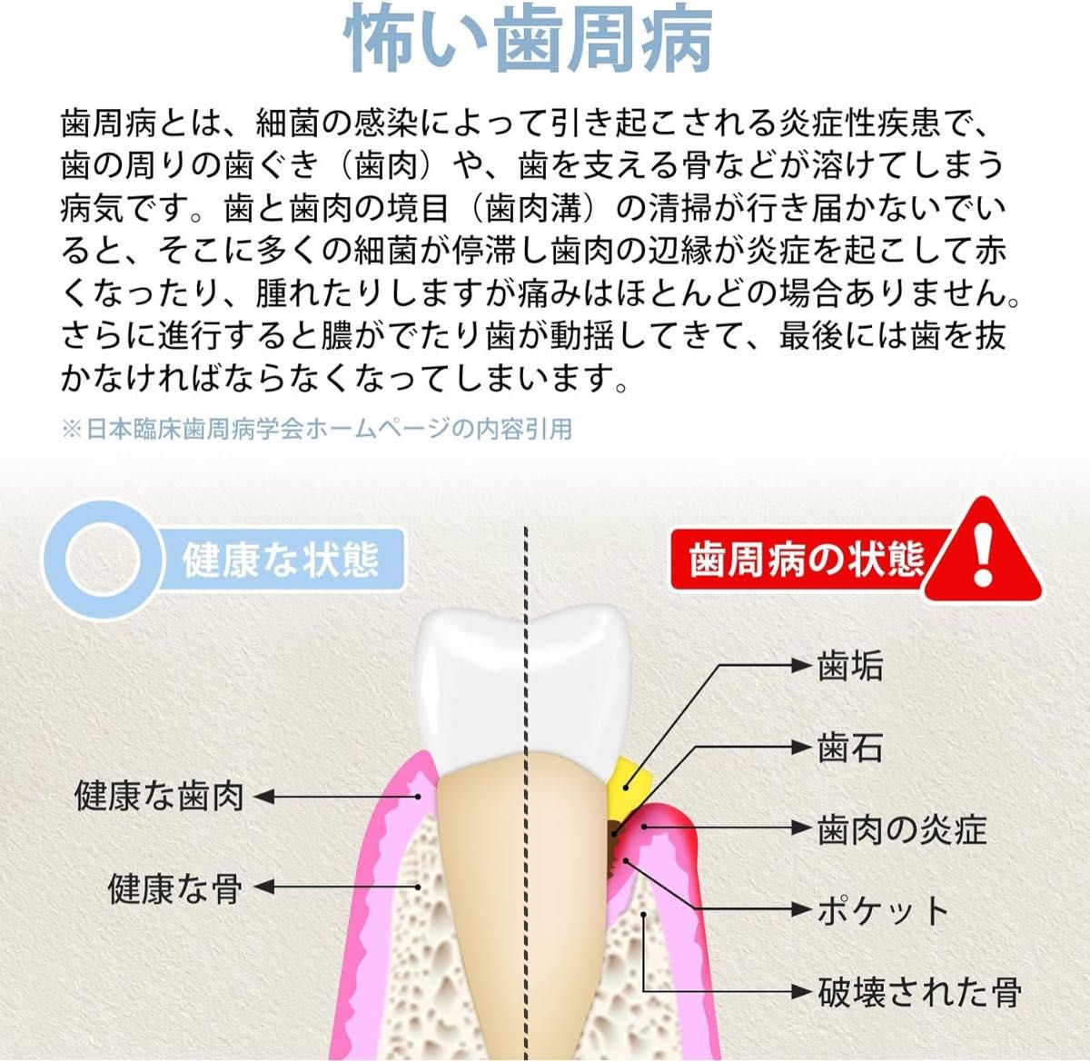 クリーニングキット 歯用ツール 歯石取り デンタルミラー スケーラー 舌ブラシ ステンレス鋼製 収納ケース付き 五点セット