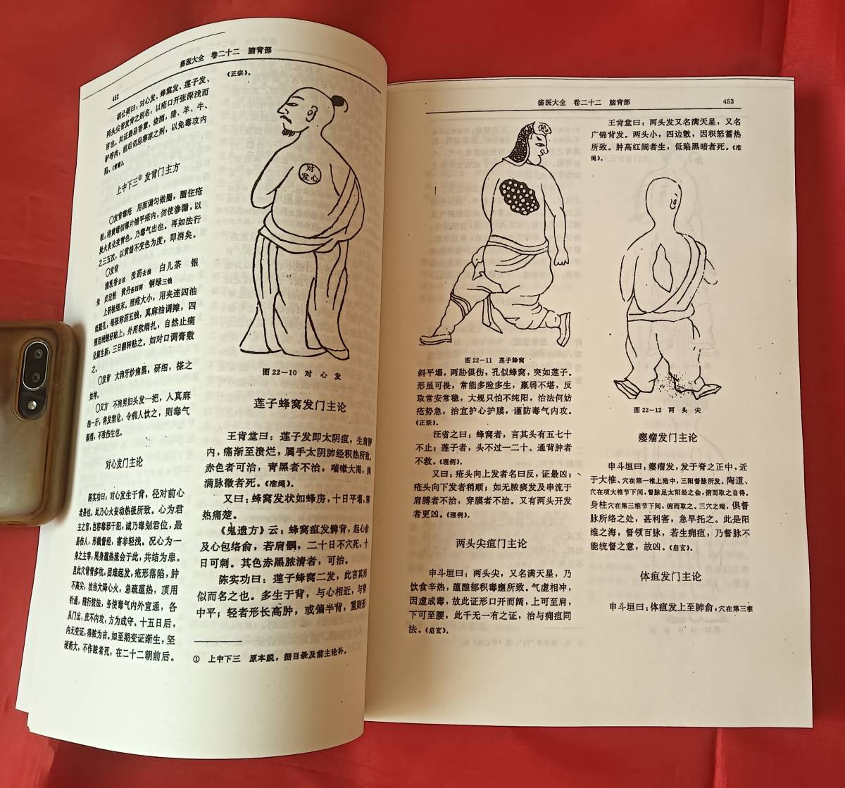 瘍医大全 明清中医名著叢刊　顧世澄　中国中医薬出版社　1994年 中文 中国語_画像4