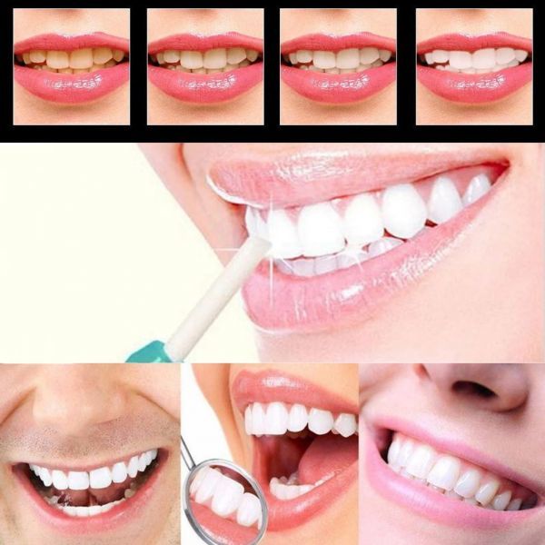 送料無料 歯を白くする 歯の消しゴム ナノ ホワイトニング ブラシ 歯をきれいに 洗浄 本体+交換カートリッジ付 25枚 セット_画像4