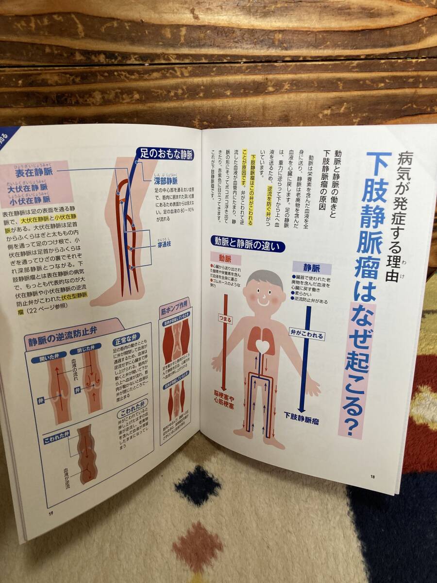 やさしく解説 下肢静脈瘤の治し方 (GEIBUN MOOKS)_画像8