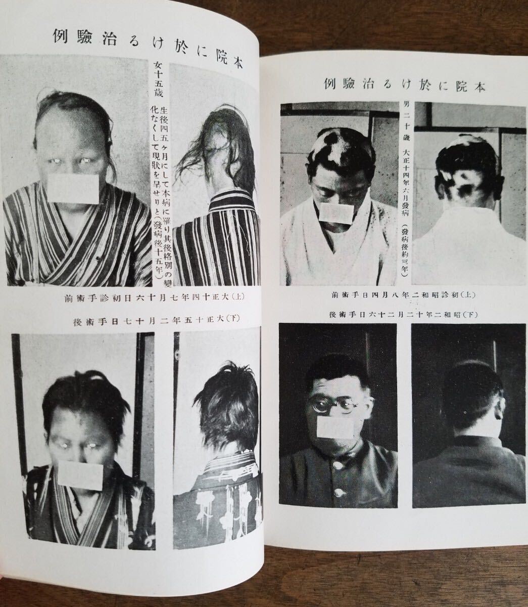 30s 戦前 円形 脱毛症 禿髪症 冊子 資料 南龍堂 医院 昭和 8年 1933年 患者 病状 病気 症状 写真 朝鮮 満洲 台湾 出征 軍人 伝染 流行 病 の画像3