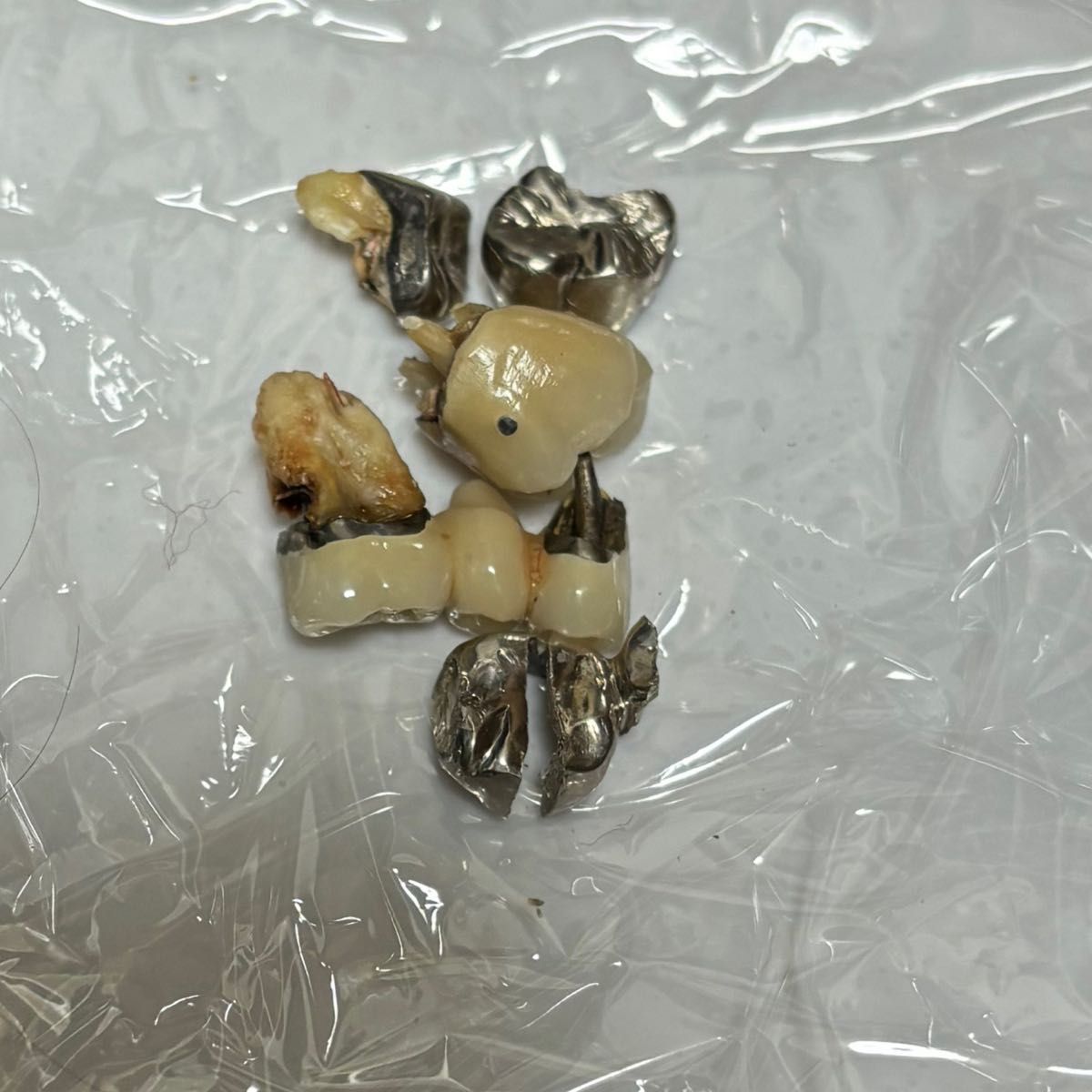 銀歯　歯科　金属