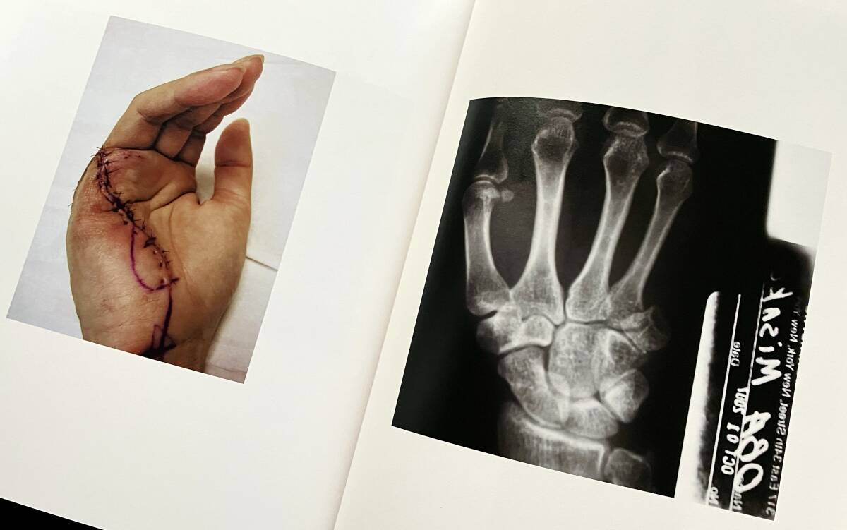 【写真集】『 FAUSTUS ファウストス 』大庭みさこ 蒼穹舎 2014 ●2006年、右手小指がAVM(動静脈奇形)という稀な自然出血症状に見舞われる。_画像9