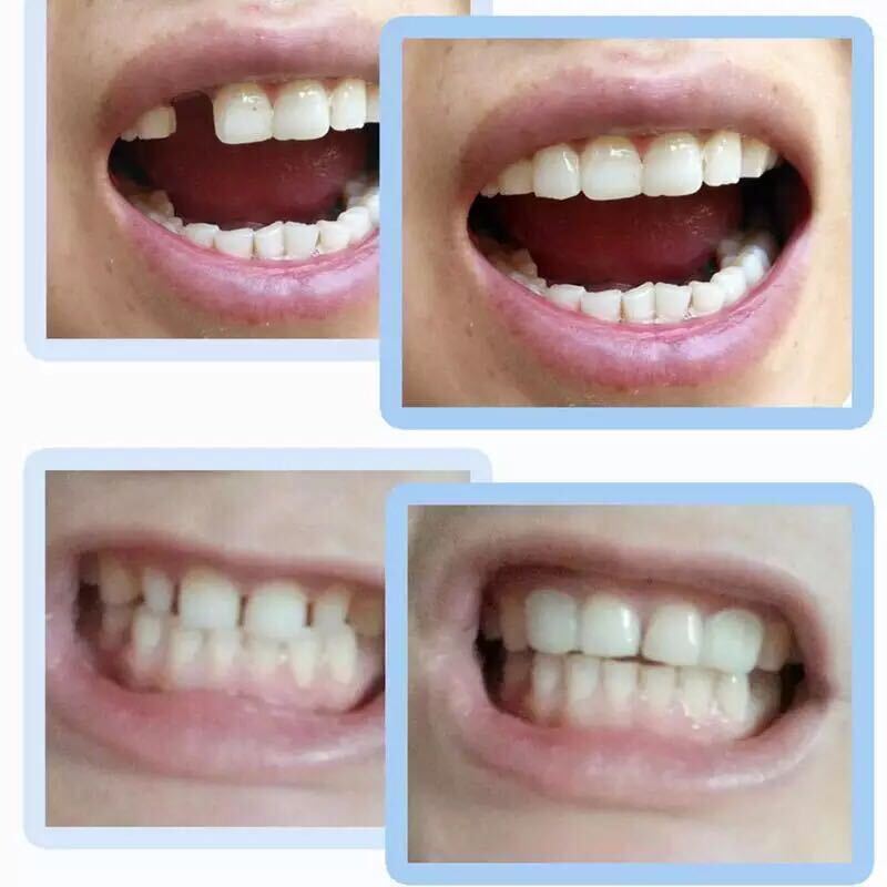 歯科ビーズ インスタントスマイル テンポラリートゥース 義歯 仮歯 差歯 歯の損傷部分を形成＆補修＆粘着 フィッティングビーズ１０ｇ　2_画像4