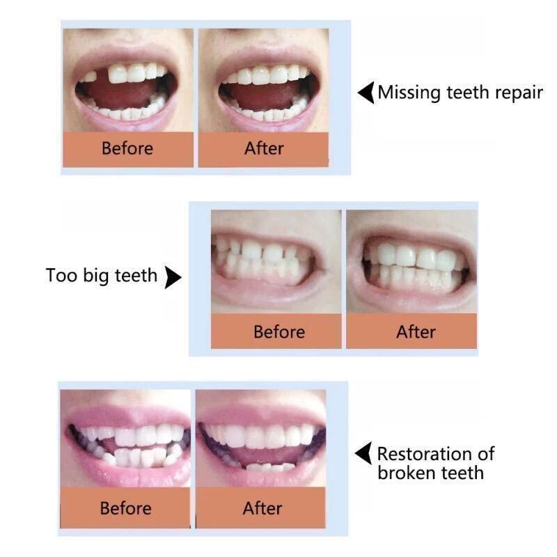 歯科ビーズ インスタントスマイル テンポラリートゥース 義歯 仮歯 差歯 歯の損傷部分を形成＆補修＆粘着 フィッティングビーズ１０ｇ　8_画像6