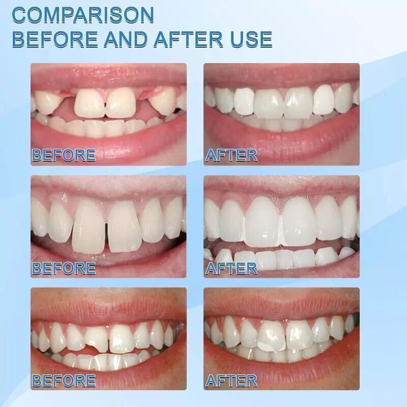 インスタントスマイル テンポラリートゥース 歯科修復ビーズ フィッティングビーズ 歯の損傷部分を形成 義歯 入れ歯 仮歯 ３０ｇサイズ bの画像3