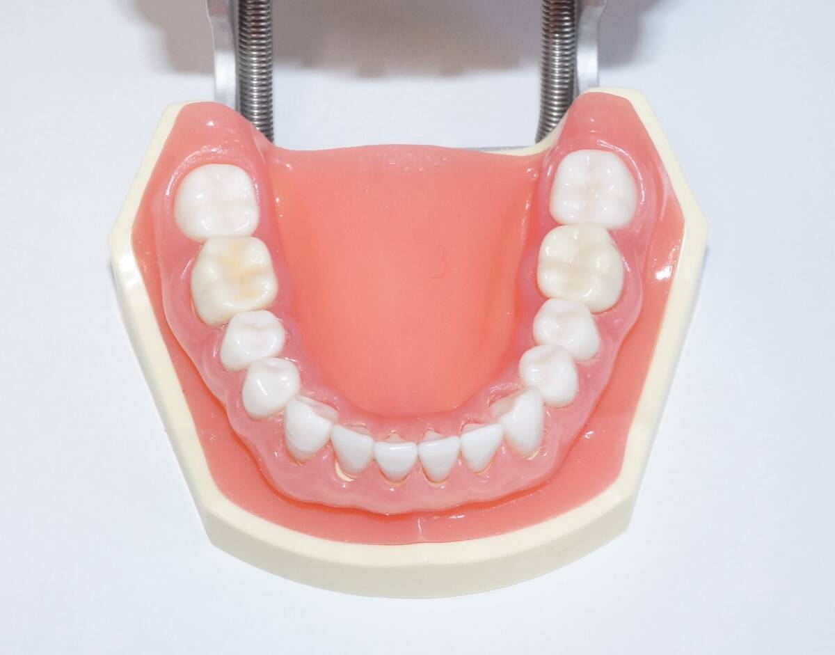NISSIN 歯周病 歯科 模型 歯周外科 顎模型 歯科衛生士 ニッシン スケーリング スケーラー SRP 歯肉 歯石 マネキン 超音波 ペリオ 額模型_画像9
