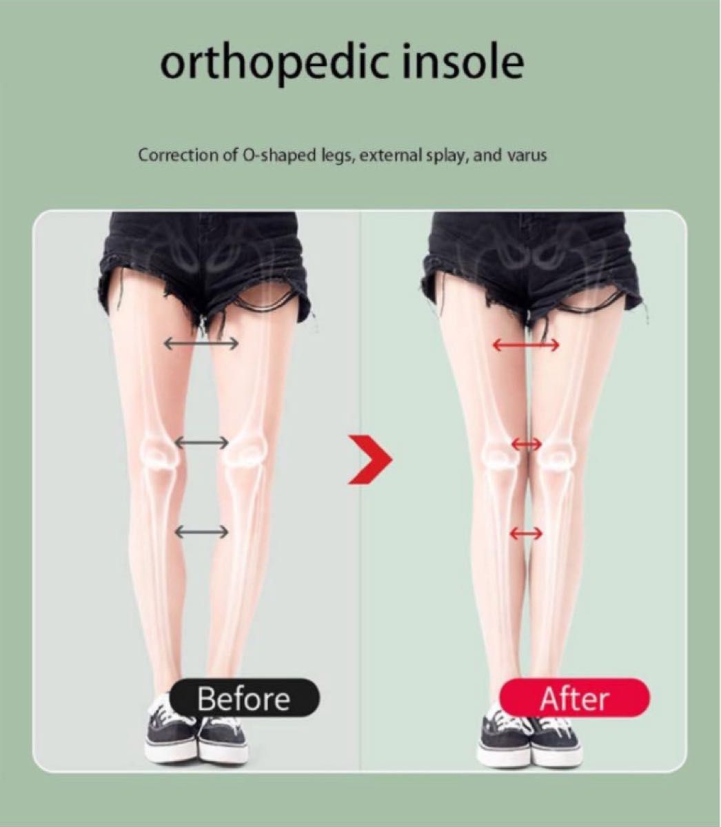 O字型の脚整形外科用インソール　長さ調整可能　約２５㎝　中敷　歩行姿勢補正　靴　シューズ