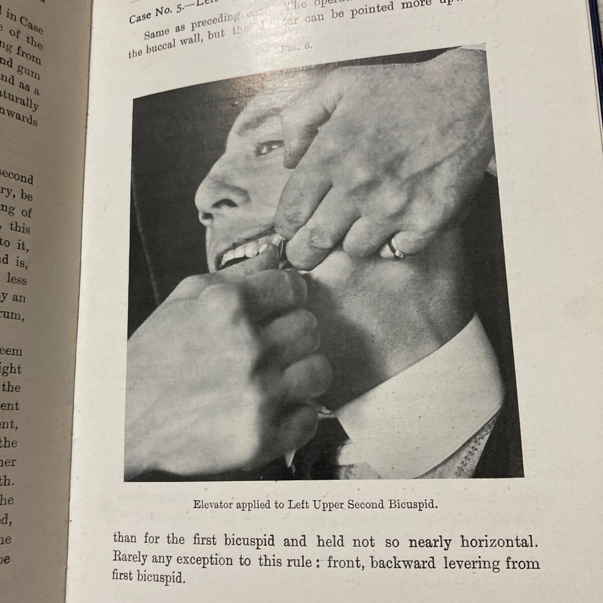Bibian 比比昂- 1914年THE SCIENCE OF THE DENTAL ELEVATOR Bibian 比比昂- 1914年THE SCIENCE OF THE DENTAL ELEVATOR