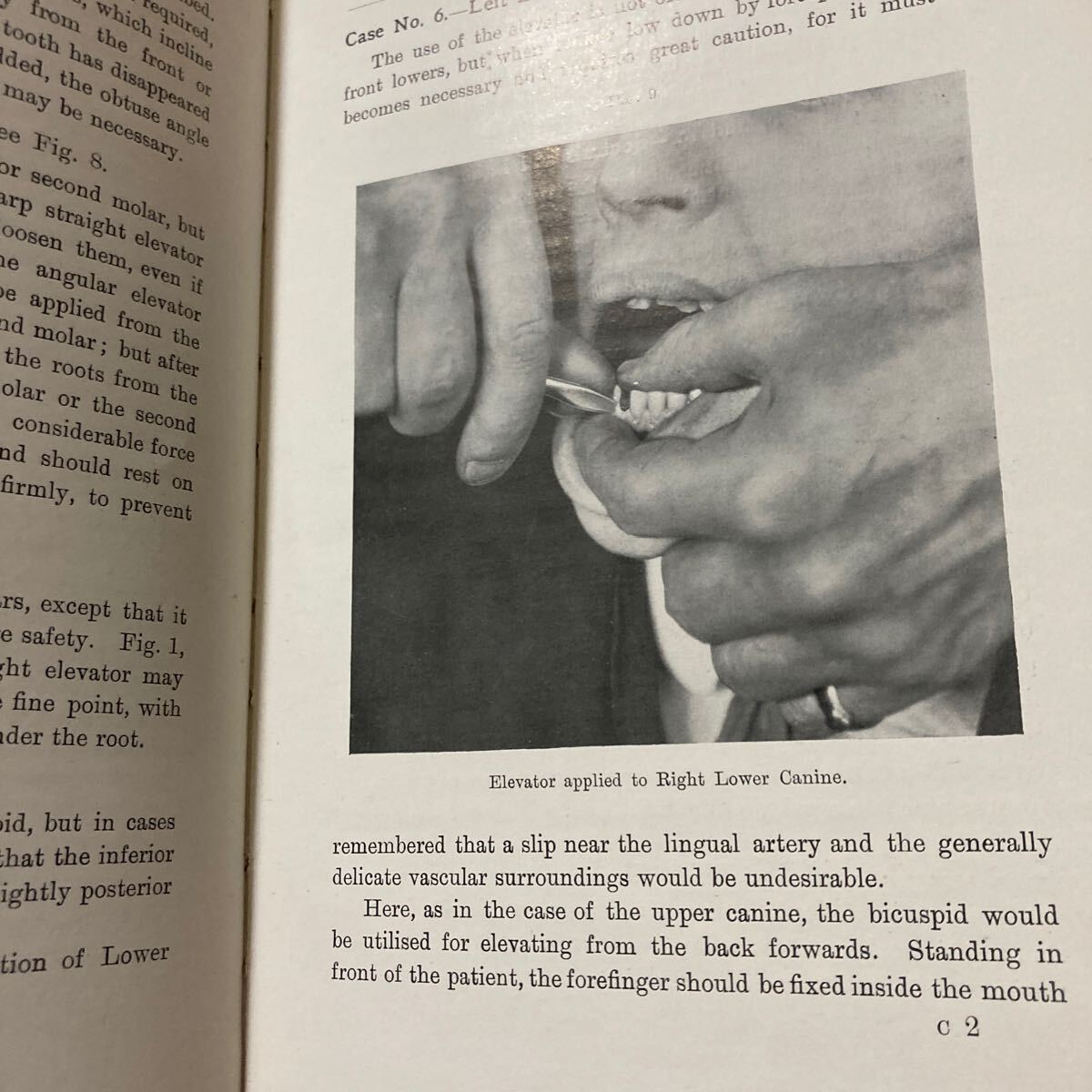 Bibian 比比昂- 1914年THE SCIENCE OF THE DENTAL ELEVATOR Bibian 比比昂- 1914年THE SCIENCE OF THE DENTAL ELEVATOR