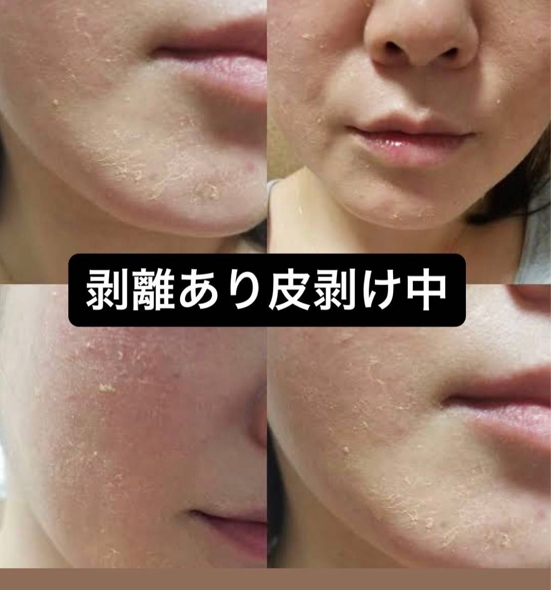 ハーブピーリング 剥離あり 皮向けあり 5回分 針状美容液|Yahoo ハーブピーリング 剥離あり 皮向けあり 5回分 針状美容液|Yahoo