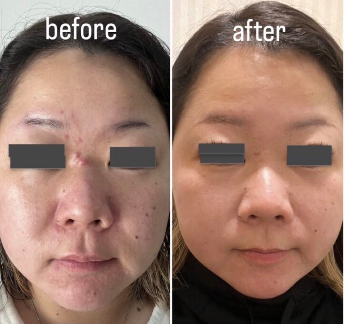 ハーブピーリング 剥離あり 皮向けあり 5回分 針状美容液|Yahoo ハーブピーリング 剥離あり 皮向けあり 5回分 針状美容液|Yahoo