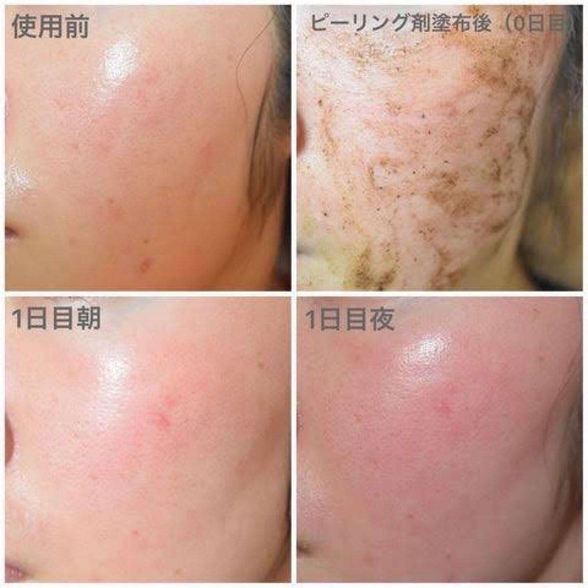 ハーブピーリング 剥離あり 皮向けあり 5回分 針状美容液|Yahoo ハーブピーリング 剥離あり 皮向けあり 5回分 針状美容液|Yahoo