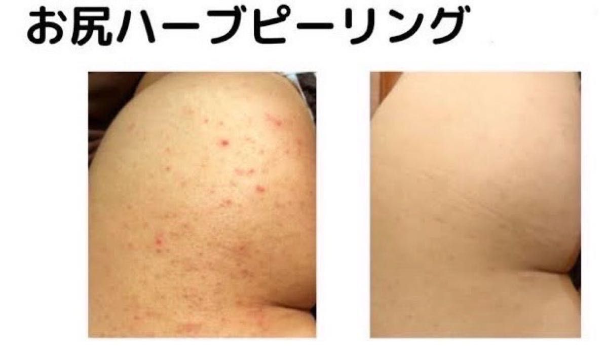 ハーブピーリング ボディ&フェイス 剥離あり皮向けあり 7g ハーブピーリング ボディ&フェイス 剥離あり皮向けあり 7g
