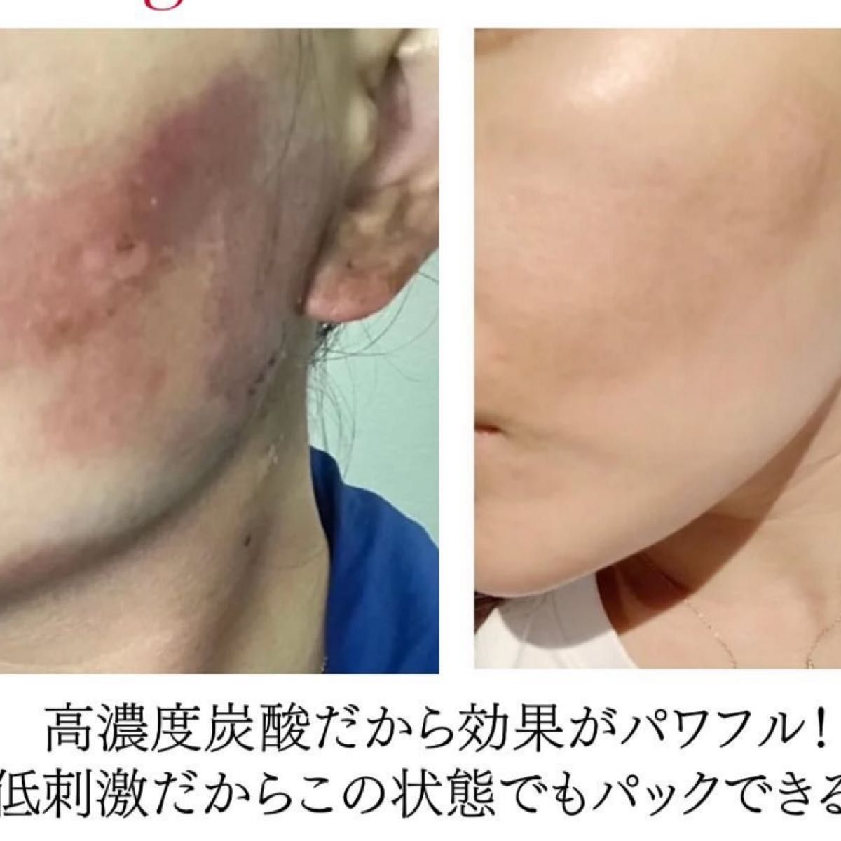 Sango炭酸パック30回分|Yahoo!フリマ(旧PayPayフリマ) Sango炭酸パック30回分|Yahoo!フリマ(旧PayPayフリマ)